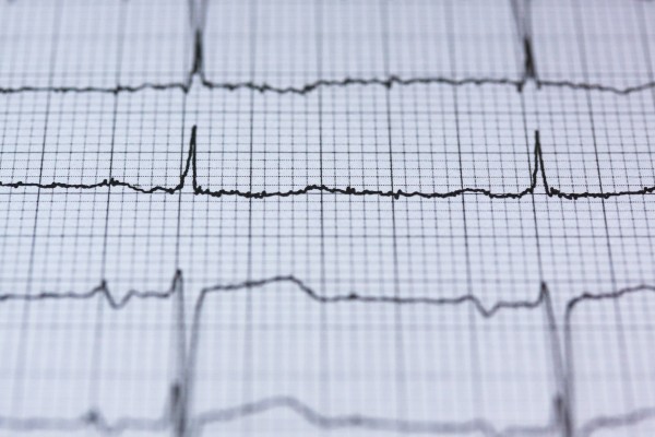 EKG zapis na papiru.